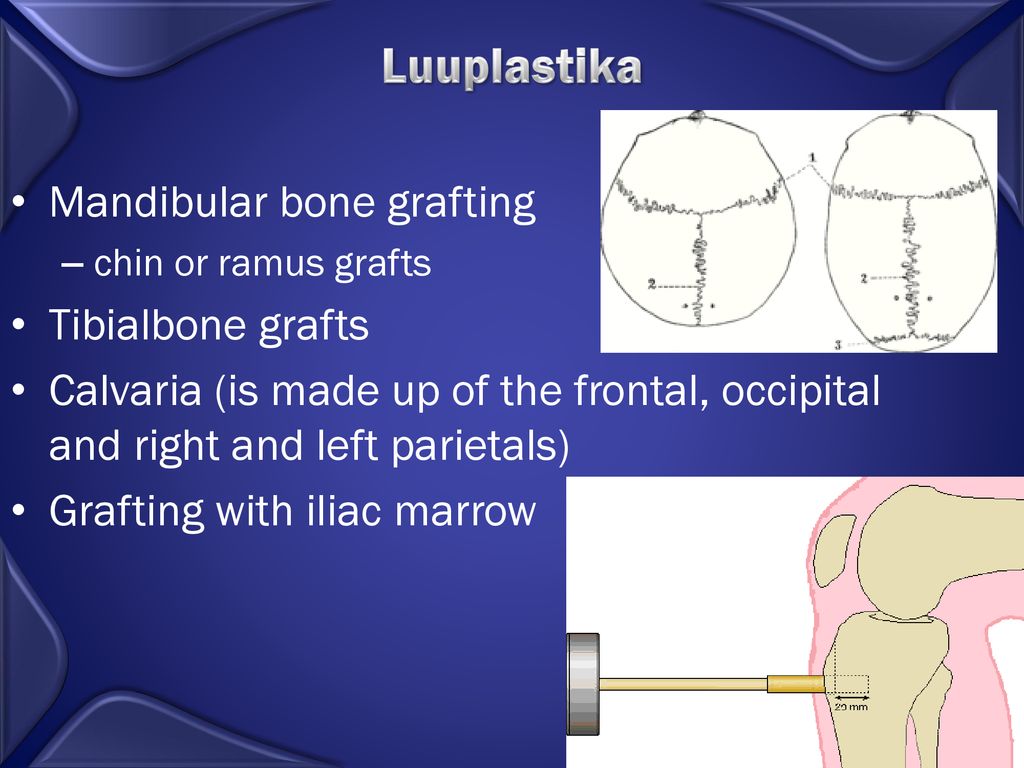 Luuplastika Mandibular bone grafting Tibialbone grafts